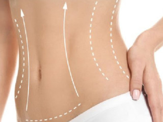 Best Cellulite Treatment Surrey