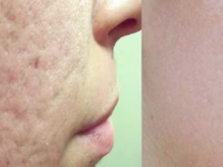 Morpheus8 Microneedling Treatment