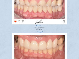 Are You Considering Invisalign Birmingham for a Straighter Smile?