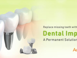 Affordable and Effective Dental Implants in India