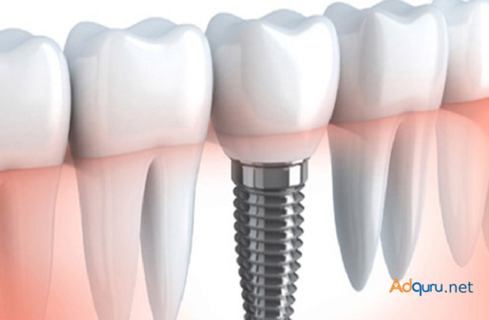 most-affordable-root-canal-treatment-cost-in-india-big-0