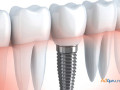 most-affordable-root-canal-treatment-cost-in-india-small-0