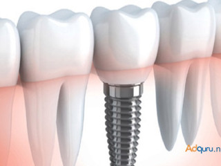 Most Affordable Root Canal Treatment Cost in India