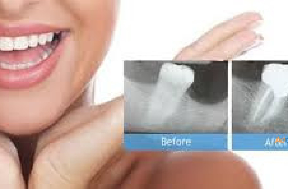 root-canal-treatment-in-kandivali-east-in-just-one-day-big-0