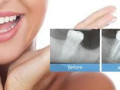 root-canal-treatment-in-kandivali-east-in-just-one-day-small-0