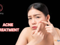 acne-treatment-in-bangalore-charma-clinic-small-0