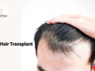 FUE Hair Transplant In Gurgaon - SB Trichology