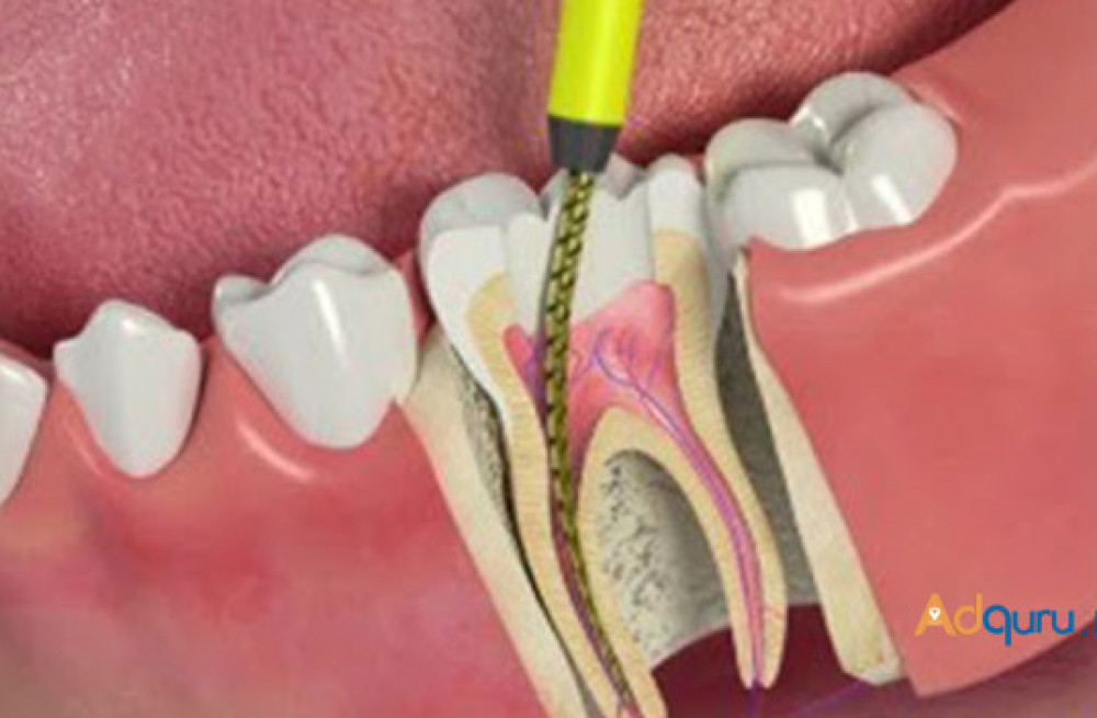 world-class-treatment-for-root-canal-in-india-with-affordable-cost-big-0