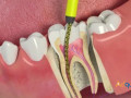 world-class-treatment-for-root-canal-in-india-with-affordable-cost-small-0