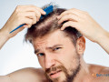 affordable-hair-transplant-cost-in-gurgaon-small-0