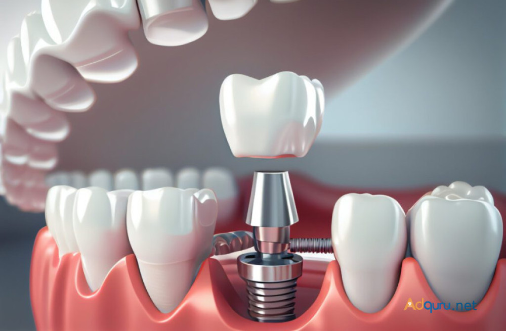 affordable-dental-implants-in-india-big-2