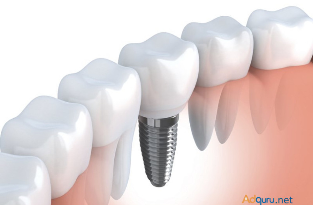 affordable-dental-implants-in-india-big-1