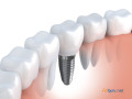 affordable-dental-implants-in-india-small-1