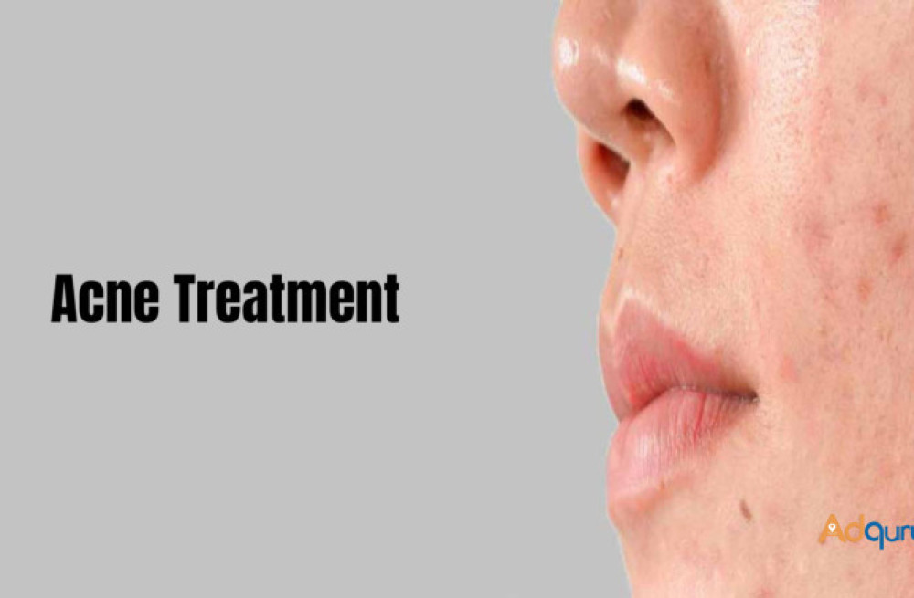 best-acne-treatment-in-bangalore-at-charma-clinic-big-0