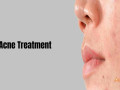 best-acne-treatment-in-bangalore-at-charma-clinic-small-0