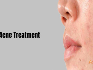 Best Acne Treatment in Bangalore At Charma Clinic