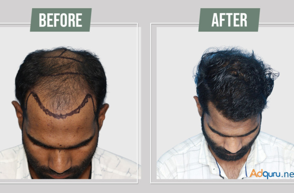 hair-transplant-services-in-jodhpur-big-0