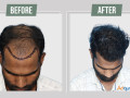 hair-transplant-services-in-jodhpur-small-0