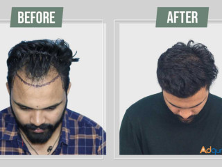 Hair Transplant in udaipur