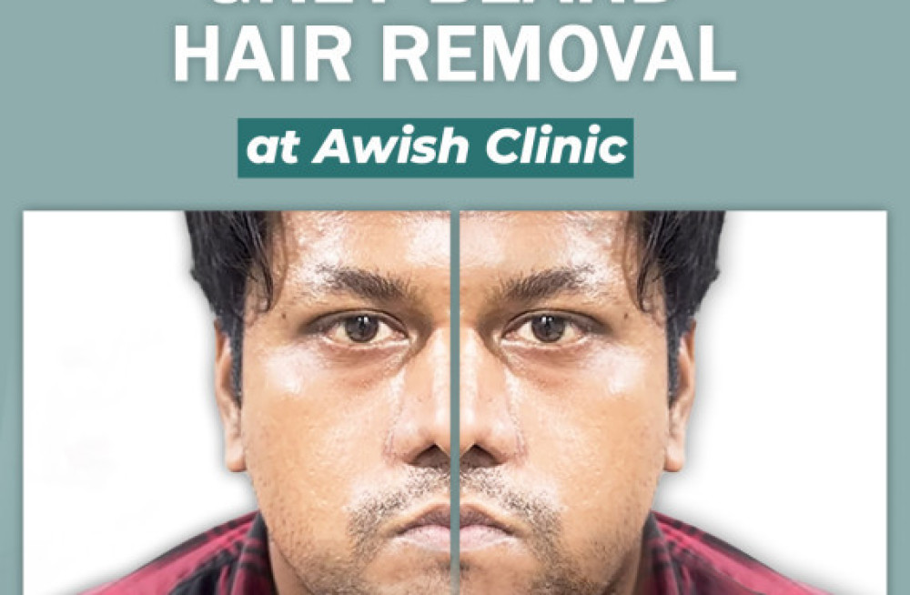 dr-vijay-kumar-best-dermatologist-specialist-in-delhi-ncr-awish-clinic-big-4