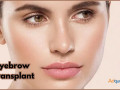 eyebrows-transplant-in-gurgaon-at-sb-trichology-small-0