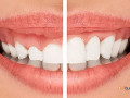 best-dental-clinic-in-gurgaon-small-1