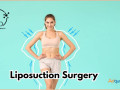 best-liposuction-surgery-in-bangalore-small-0