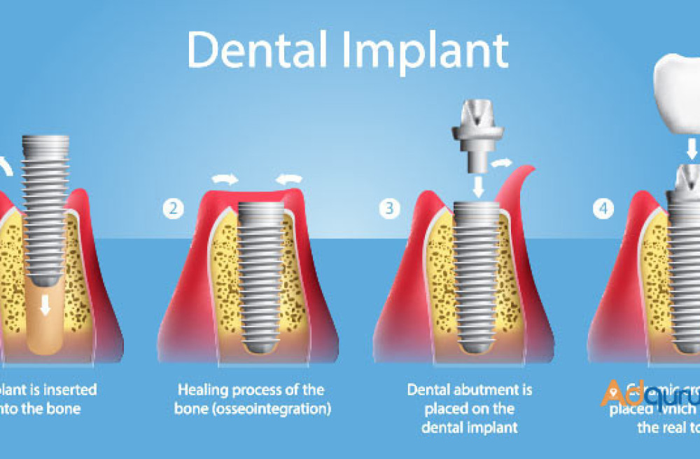 cost-effective-dental-implants-in-india-big-0