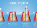 cost-effective-dental-implants-in-india-small-0