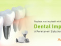 cost-effective-dental-implants-in-india-small-1