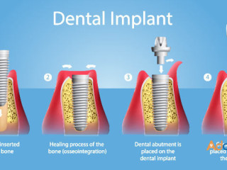 Cost Effective Dental Implants in India