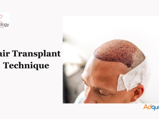 Hair Transplant Techniques in Gurgaon at SB Trichology