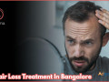 best-hair-loss-treatment-in-bangalore-at-charma-clinic-small-0