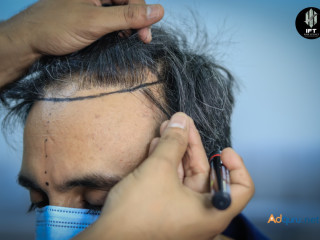 Hair transplant in Kota