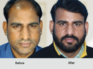 Hair transplant in Ajmer