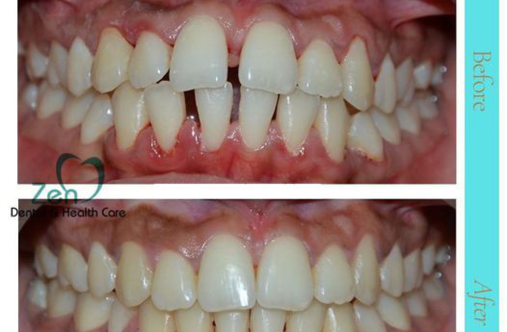 transform-your-smile-with-dental-braces-treatment-in-bangalore-big-0