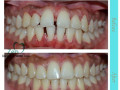 transform-your-smile-with-dental-braces-treatment-in-bangalore-small-0