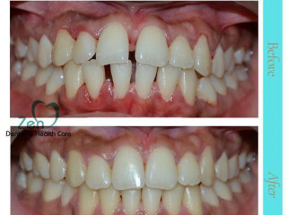 Transform Your Smile with Dental Braces Treatment in Bangalore