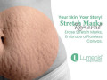 effective-stretch-marks-removal-in-anjuna-goa-small-0