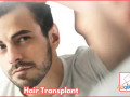 hair-transplant-cost-in-gurgaon-sb-trichology-clinic-small-0