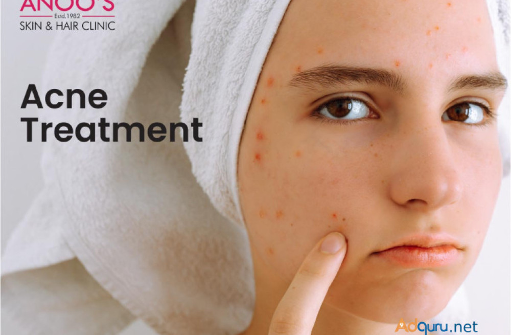 advanced-acne-removal-treatment-at-anoos-big-0