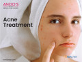 advanced-acne-removal-treatment-at-anoos-small-0