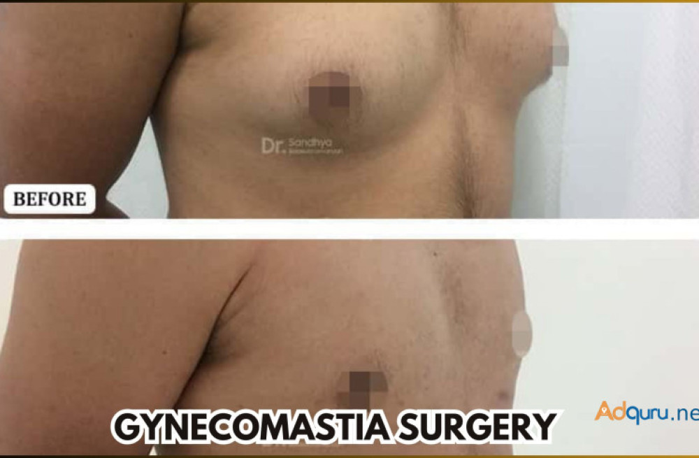 get-gynecomastia-surgery-in-bangalore-big-0