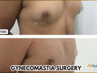 Get Gynecomastia Surgery In Bangalore