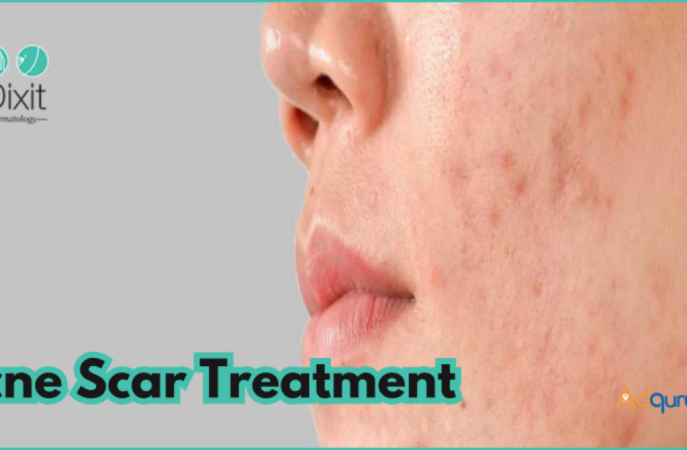 acne-treatment-in-bangalore-lowest-cost-estimate-big-0