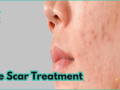 acne-treatment-in-bangalore-lowest-cost-estimate-small-0