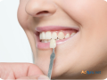 get-stunning-results-with-the-smile-spas-professional-teeth-whitening-services-small-0