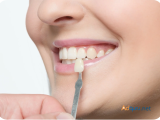 Get Stunning Results with The Smile Spa's Professional Teeth Whitening Services