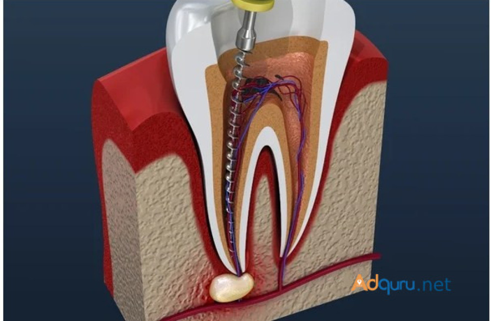 root-canal-treatment-in-goria-big-0