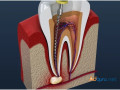 root-canal-treatment-in-goria-small-0